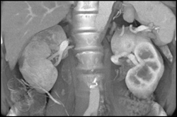 Transitional Cell Carcinoma of the Left Kidney - CTisus CT Scan