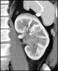 Transitional Cell Carcinoma of the Left Kidney - CTisus CT Scan