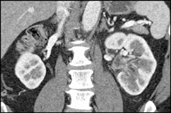 Transitional Cell Carcinoma of the Left Kidney - CTisus CT Scan