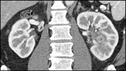 Transitional Cell Carcinoma of the Left Kidney - CTisus CT Scan