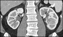 Transitional Cell Carcinoma of the Left Kidney - CTisus CT Scan