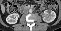 Transitional Cell Carcinoma of the Left Kidney - CTisus CT Scan