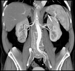 Carcinoma of the Right Kidney With Bone Metastases - CTisus CT Scan