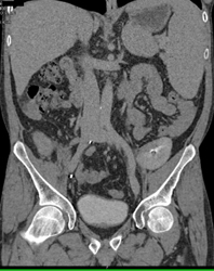 Lymphoma in Transplant Kidney - CTisus CT Scan