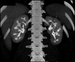 Multiple Polyps in Left Renal Pelvis and Collecting Systems - CTisus CT Scan