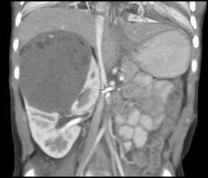 Wilms Tumor - CTisus CT Scan