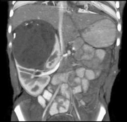 Wilms Tumor - CTisus CT Scan