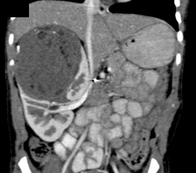 Wilms Tumor - CTisus CT Scan