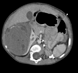 Wilms Tumor - CTisus CT Scan