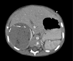 Wilms Tumor - CTisus CT Scan