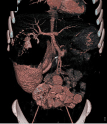 Wilms Tumor - CTisus CT Scan