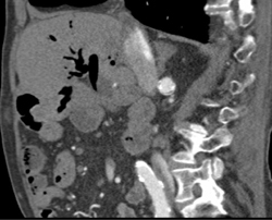 Right Renal Artery Aneurysm - CTisus CT Scan