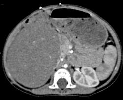 Wilms Tumor - CTisus CT Scan