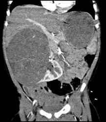 Wilms Tumor - CTisus CT Scan