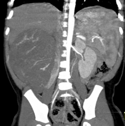 Wilms Tumor - CTisus CT Scan