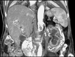 Retroperitoneal Fibrosis - CTisus CT Scan