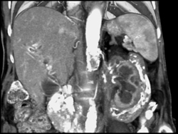 Retroperitoneal Fibrosis - CTisus CT Scan