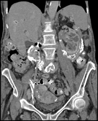 Retroperitoneal Fibrosis - CTisus CT Scan