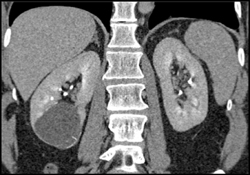 Bosniak Type Ii Cyst - CTisus CT Scan