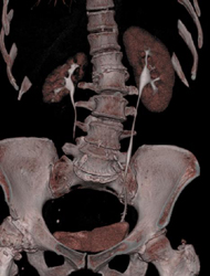 Chronic Pyelonephritis of Right Kidney - CTisus CT Scan