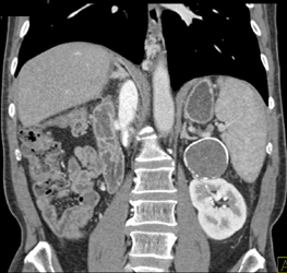 Calcified Renal Cyst - CTisus CT Scan