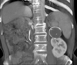 Calcified Renal Cyst - CTisus CT Scan