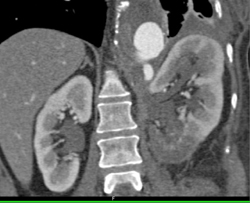 Left Renal Infarct - CTisus CT Scan