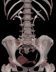 Scarred Right Kidney - CTisus CT Scan