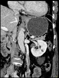 Clot in Left Gonadal Vein - CTisus CT Scan