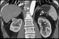 Vascular Right Renal Mass-hemangiopericytoma - CTisus CT Scan