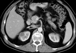 Vascular Right Renal Mass-hemangiopericytoma-case 98, One Year Earlier - CTisus CT Scan