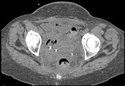 Pelvic Tumor Infiltration Encases the Bladder - CTisus CT Scan