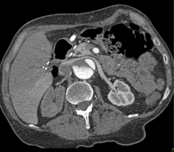 Aortic Dissection Results in Delayed Function of Right Kidney - CTisus CT Scan