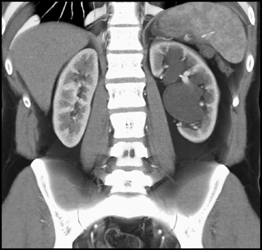 Dilated Calyces in Left Kidney With Ureteropelvic Junction (UPJ) Due to Crossing Vessel - CTisus CT Scan