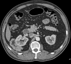 Angiomyolipoma of the Kidney - CTisus CT Scan