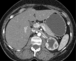 Retroperitoneal Fibrosis Encases the Left Renal Artery - CTisus CT Scan