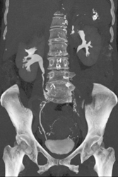 Ct Urogram With Renal Cyst - CTisus CT Scan