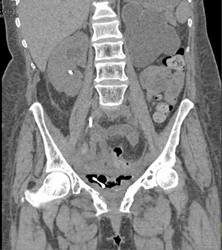 Pelvic Abscess With Tumor Infiltration of the Bladder - CTisus CT Scan