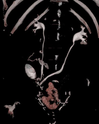 Ileal Loop With Neobladder - CTisus CT Scan