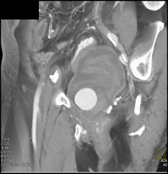 Internal Pudendal Artery Aneurysm S/P Prostate Surgery - CTisus CT Scan