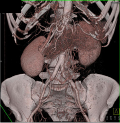 Normal Renal CTA - CTisus CT Scan