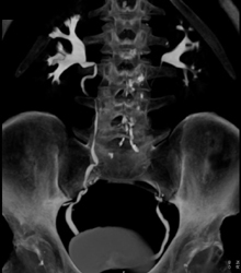 Normal CT Urogram - CTisus CT Scan