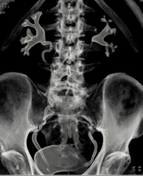 Normal CT Urogram - CTisus CT Scan