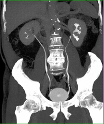 Transitional Cell Cancer (TCC) Left Renal Pelvis - CTisus CT Scan