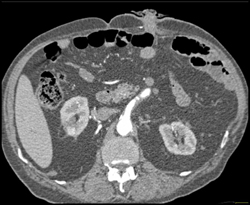 Renal Cell Carcinoma Recurrence S/P Radiofrequency Ablation (RFA) - CTisus CT Scan