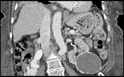 Calcified Renal Cyst - CTisus CT Scan