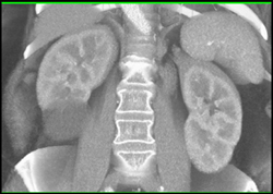 Renal Cyst - CTisus CT Scan