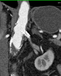 Patent Stent in Renal Artery - CTisus CT Scan