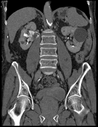 Transitional Cell Carcinoma - CTisus CT Scan