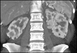 Renal Cell Carcinoma - CTisus CT Scan